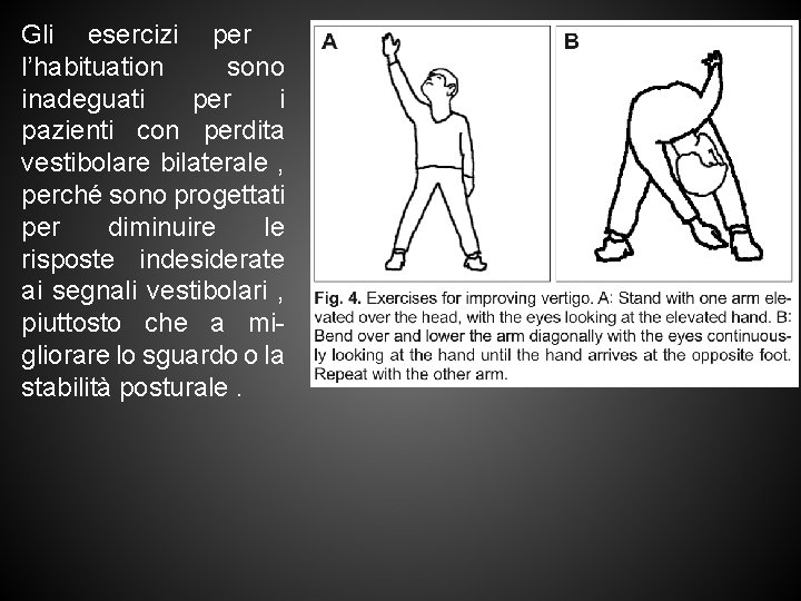 Gli esercizi per l’habituation sono inadeguati per i pazienti con perdita vestibolare bilaterale ,