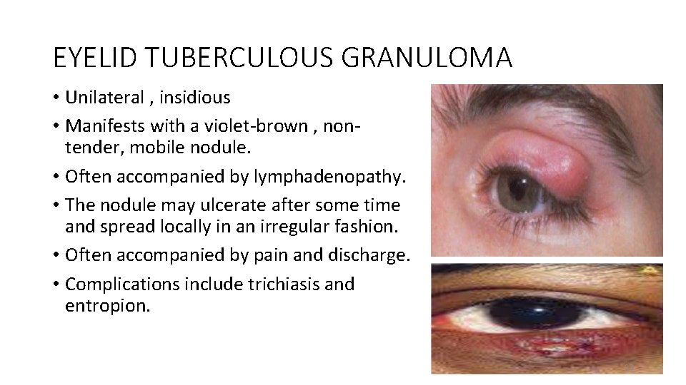 EYELID TUBERCULOUS GRANULOMA • Unilateral , insidious • Manifests with a violet-brown , nontender,