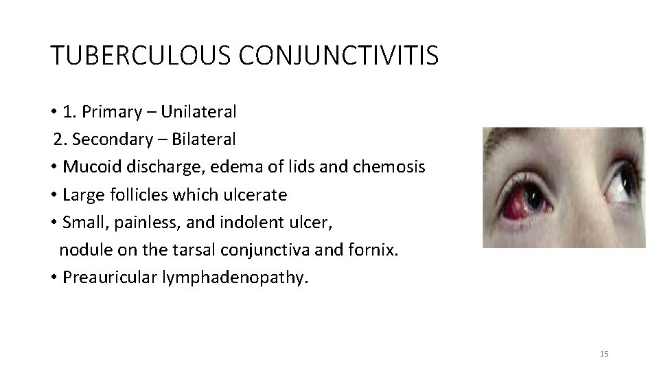 TUBERCULOUS CONJUNCTIVITIS • 1. Primary – Unilateral 2. Secondary – Bilateral • Mucoid discharge,