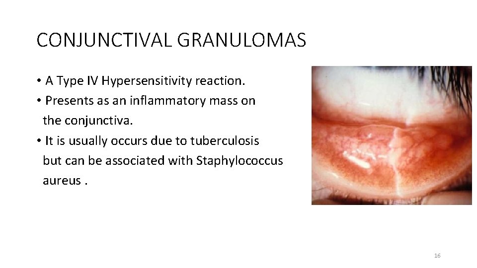 CONJUNCTIVAL GRANULOMAS • A Type IV Hypersensitivity reaction. • Presents as an inflammatory mass