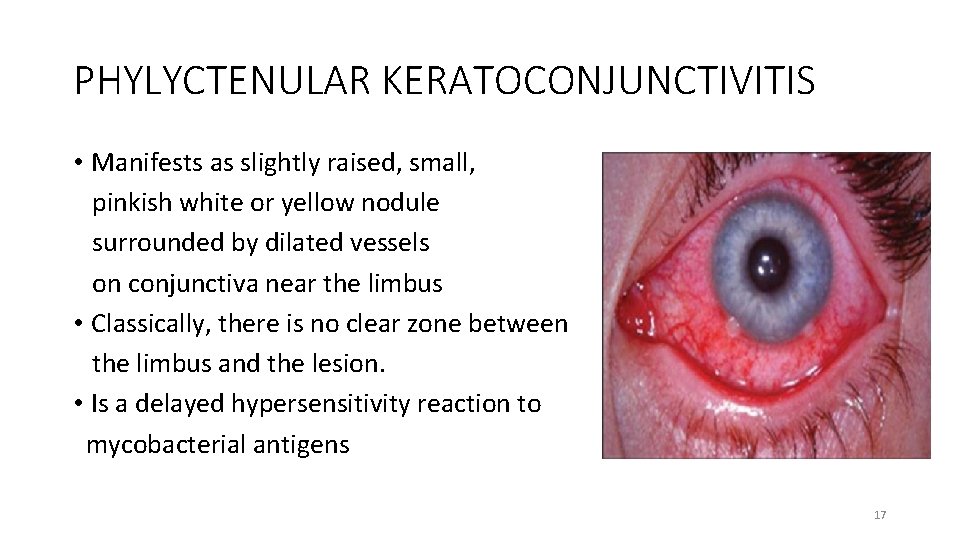 PHYLYCTENULAR KERATOCONJUNCTIVITIS • Manifests as slightly raised, small, pinkish white or yellow nodule surrounded