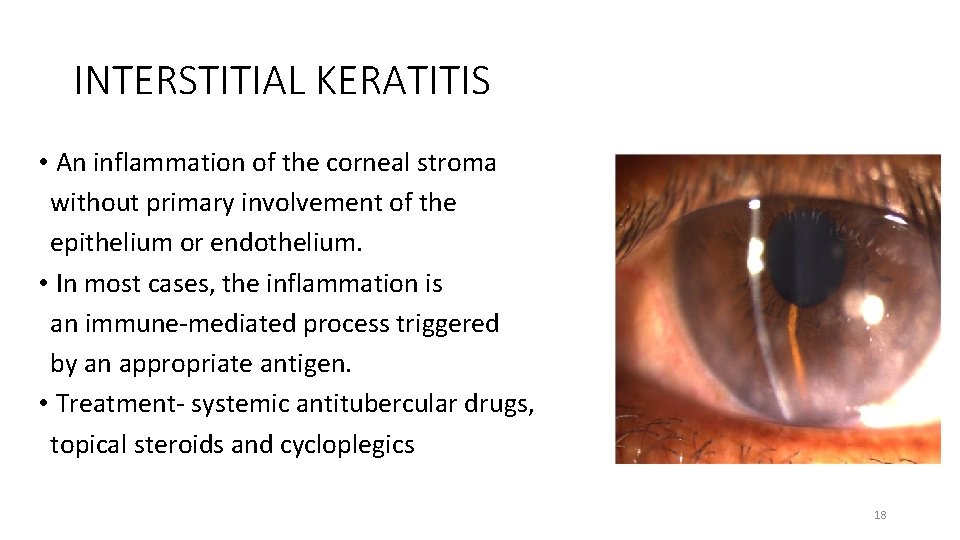 INTERSTITIAL KERATITIS • An inflammation of the corneal stroma without primary involvement of the