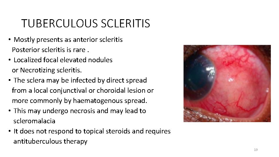 TUBERCULOUS SCLERITIS • Mostly presents as anterior scleritis Posterior scleritis is rare. • Localized