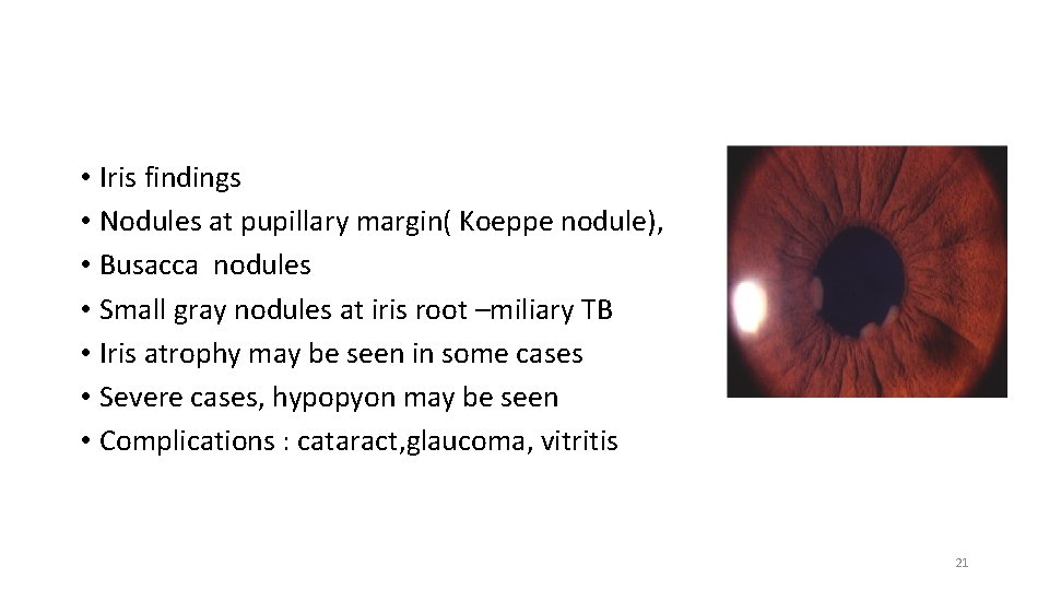  • Iris findings • Nodules at pupillary margin( Koeppe nodule), • Busacca nodules