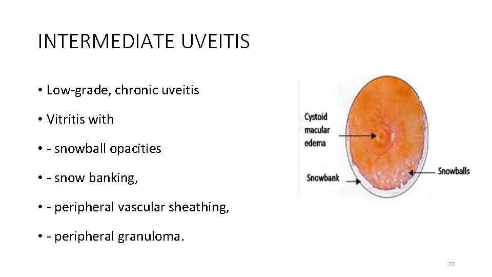 INTERMEDIATE UVEITIS • Low-grade, chronic uveitis • Vitritis with • - snowball opacities •