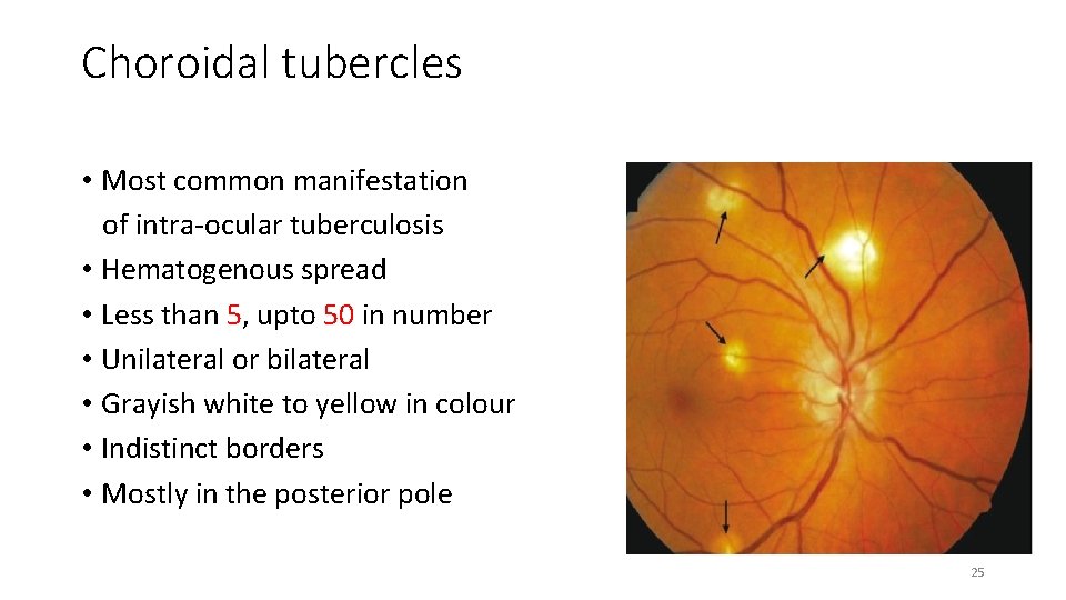 Choroidal tubercles • Most common manifestation of intra-ocular tuberculosis • Hematogenous spread • Less