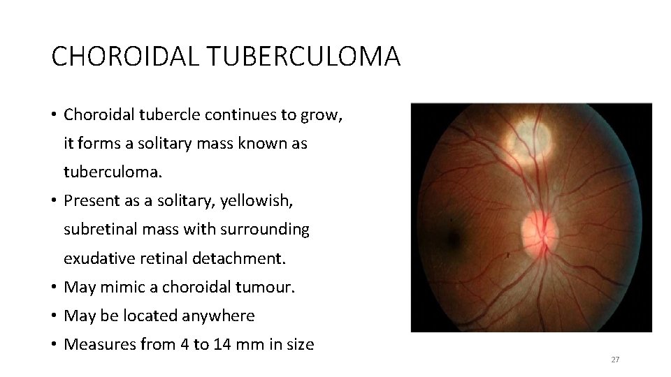 CHOROIDAL TUBERCULOMA • Choroidal tubercle continues to grow, it forms a solitary mass known