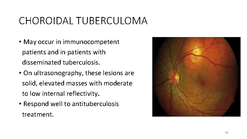 CHOROIDAL TUBERCULOMA • May occur in immunocompetent patients and in patients with disseminated tuberculosis.