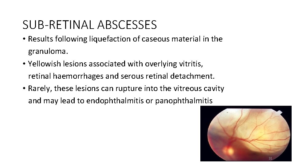 SUB-RETINAL ABSCESSES • Results following liquefaction of caseous material in the granuloma. • Yellowish