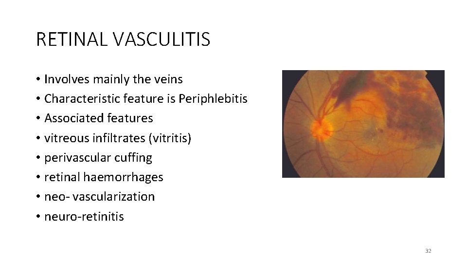 RETINAL VASCULITIS • Involves mainly the veins • Characteristic feature is Periphlebitis • Associated