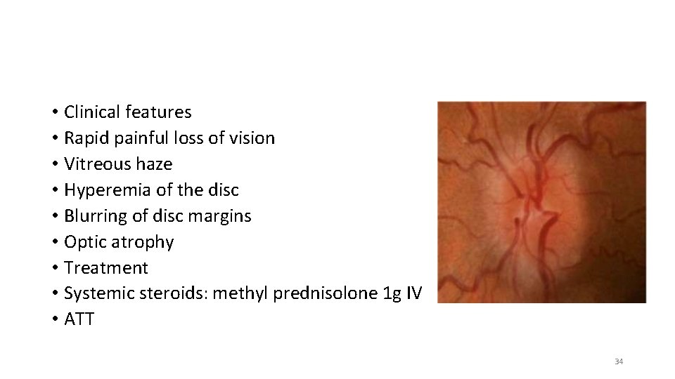  • Clinical features • Rapid painful loss of vision • Vitreous haze •