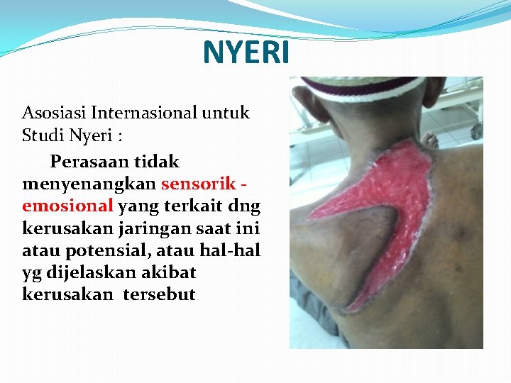  NYERI Asosiasi Internasional untuk Studi Nyeri : Perasaan tidak menyenangkan sensorik emosional yang