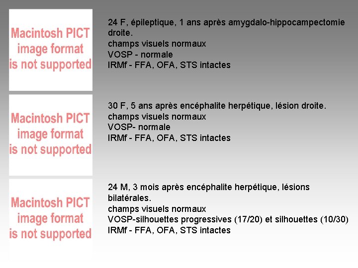 24 F, épileptique, 1 ans après amygdalo-hippocampectomie droite. champs visuels normaux VOSP - normale