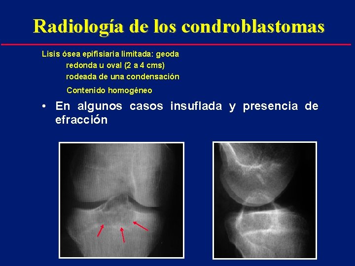 Radiología de los condroblastomas Lisis ósea epifisiaria limitada: geoda redonda u oval (2 a