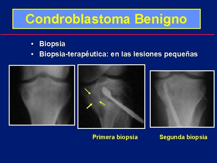 Condroblastoma Benigno • Biopsia-terapéutica: en las lesiones pequeñas Primera biopsia Segunda biopsia 