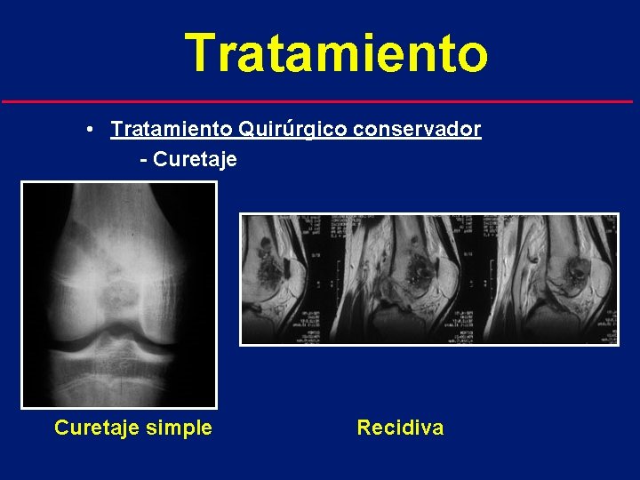 Tratamiento • Tratamiento Quirúrgico conservador - Curetaje simple Recidiva 