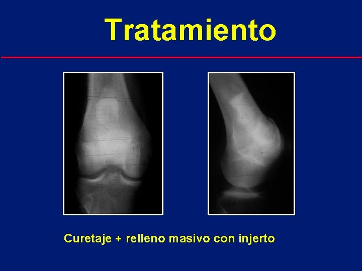 Tratamiento Curetaje + relleno masivo con injerto 