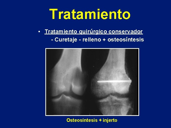 Tratamiento • Tratamiento quirúrgico conservador - Curetaje - relleno + osteosíntesis Osteosíntesis + injerto