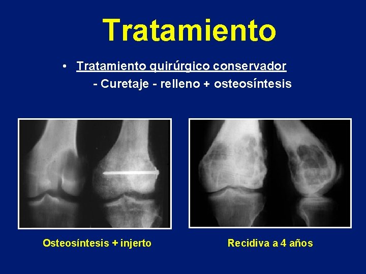 Tratamiento • Tratamiento quirúrgico conservador - Curetaje - relleno + osteosíntesis Osteosíntesis + injerto