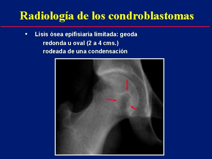 Radiología de los condroblastomas • Lisis ósea epifisiaria limitada: geoda redonda u oval (2