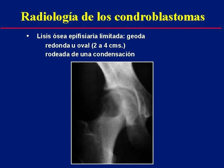 Radiología de los condroblastomas • Lisis ósea epifisiaria limitada: geoda redonda u oval (2