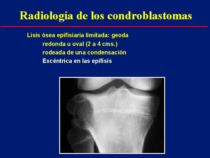 Radiología de los condroblastomas Lisis ósea epifisiaria limitada: geoda redonda u oval (2 a