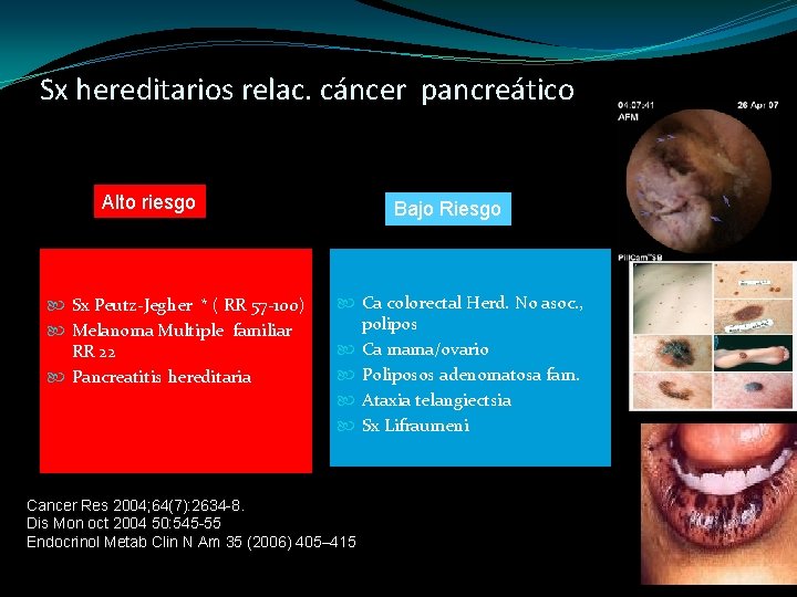 Sx hereditarios relac. cáncer pancreático Alto riesgo Sx Peutz-Jegher * ( RR 57 -100)