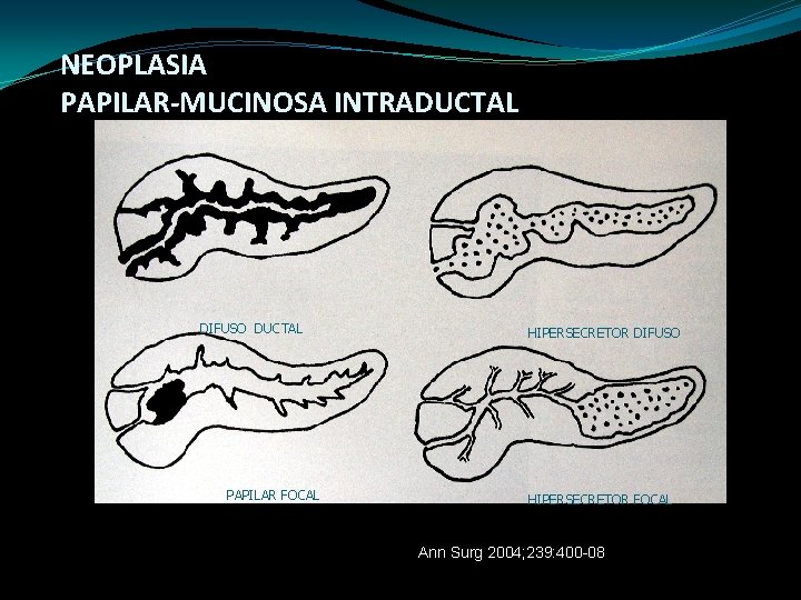 NEOPLASIA PAPILAR-MUCINOSA INTRADUCTAL DIFUSO DUCTAL PAPILAR FOCAL HIPERSECRETOR DIFUSO HIPERSECRETOR FOCAL Ann Surg 2004;