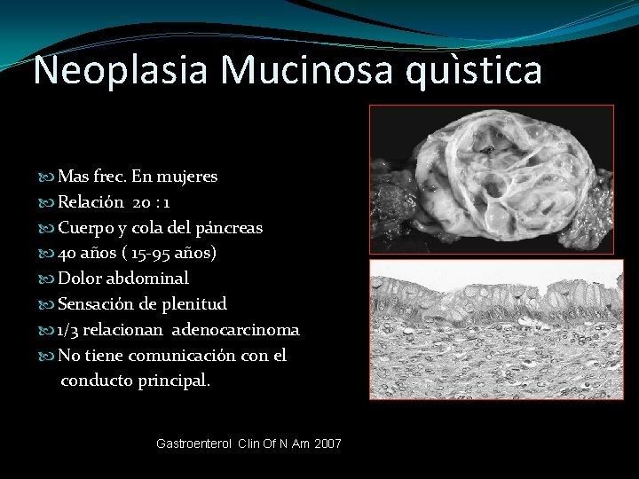 Neoplasia Mucinosa quìstica Mas frec. En mujeres Relación 20 : 1 Cuerpo y cola