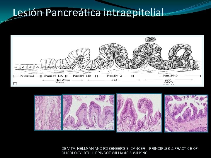 Lesión Pancreática intraepitelial DE VITA, HELLMAN AND ROSENBERG'S. CANCER. PRINCIPLES & PRACTICE OF ONCOLOGY.