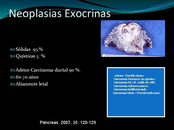 Neoplasias Exocrinas Sólidas 95 % Quísticas 5 % Adeno Carcinoma ductal 90 %. 60
