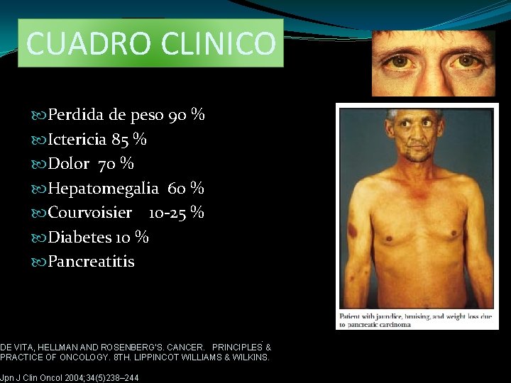 CUADRO CLINICO Perdida de peso 90 % Ictericia 85 % Dolor 70 % Hepatomegalia