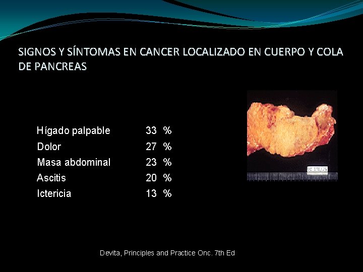 SIGNOS Y SÍNTOMAS EN CANCER LOCALIZADO EN CUERPO Y COLA DE PANCREAS Hígado palpable