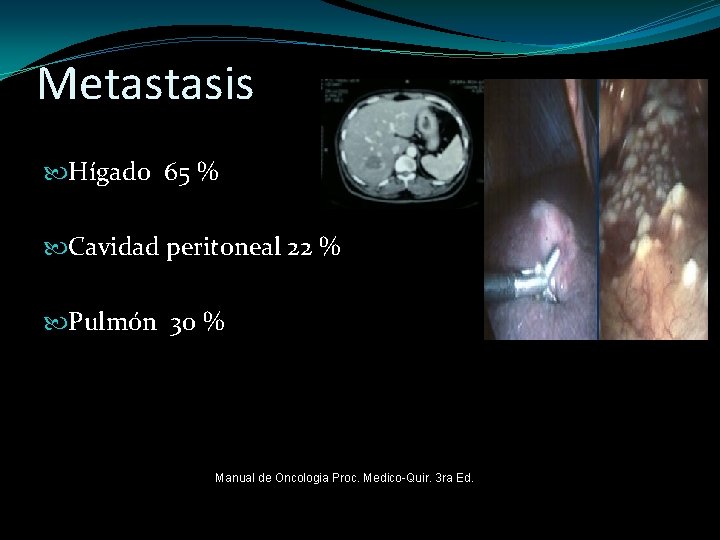 Metastasis Hígado 65 % Cavidad peritoneal 22 % Pulmón 30 % Manual de Oncologia