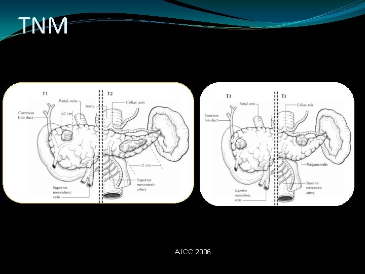 TNM AJCC 2006 