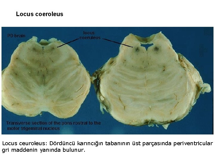 Locus coeroleus Locus ceuroleus: Dördüncü karıncığın tabanının üst parçasında periventricular gri maddenin yanında bulunur.