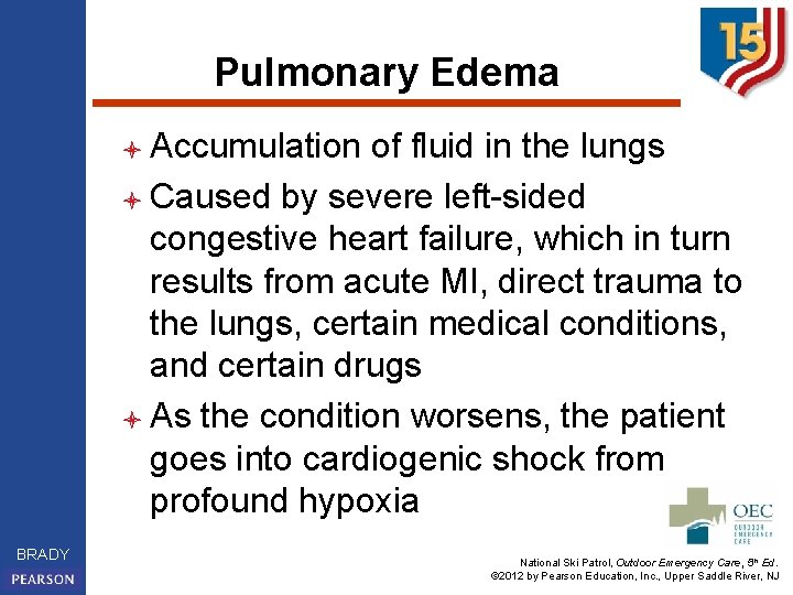 Pulmonary Edema l Accumulation of fluid in the lungs l Caused by severe left-sided