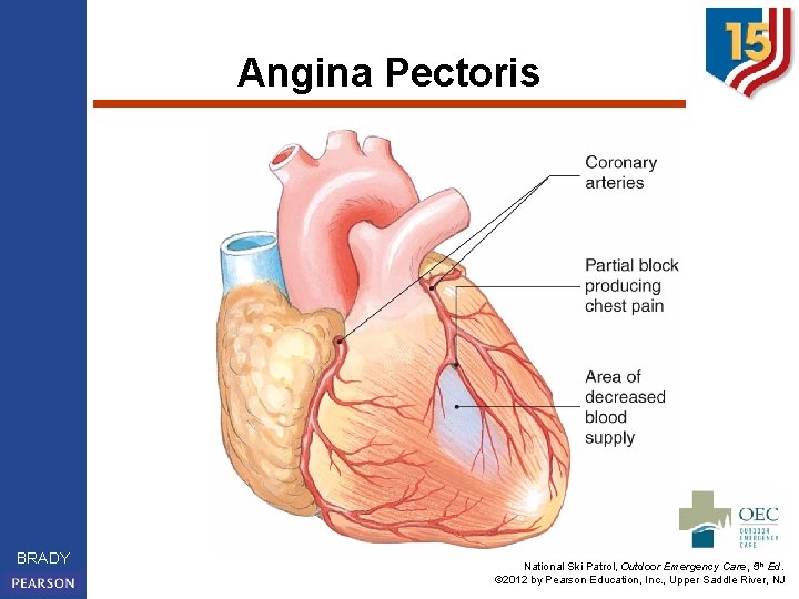 Angina Pectoris BRADY National Ski Patrol, Outdoor Emergency Care, 5 th Ed. © 2012