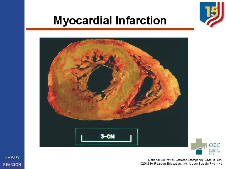 Myocardial Infarction BRADY National Ski Patrol, Outdoor Emergency Care, 5 th Ed. © 2012