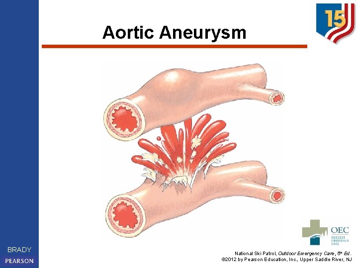 Aortic Aneurysm BRADY National Ski Patrol, Outdoor Emergency Care, 5 th Ed. © 2012