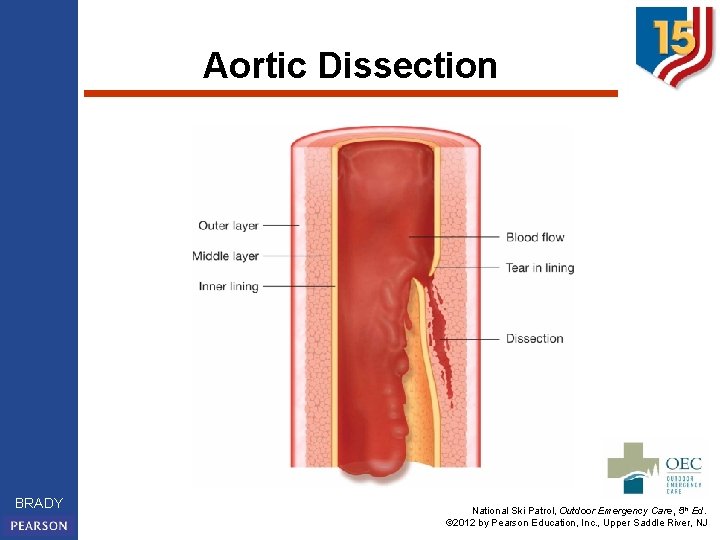 Aortic Dissection BRADY National Ski Patrol, Outdoor Emergency Care, 5 th Ed. © 2012