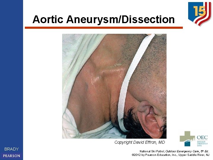 Aortic Aneurysm/Dissection Copyright David Effron, MD BRADY National Ski Patrol, Outdoor Emergency Care, 5