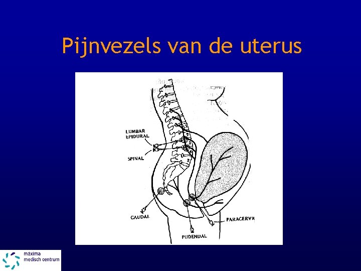 Pijnvezels van de uterus 