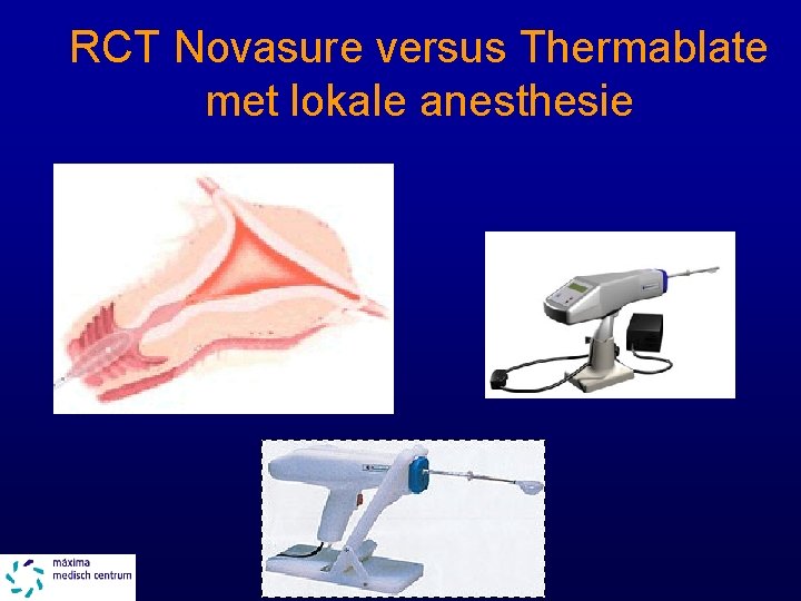 RCT Novasure versus Thermablate met lokale anesthesie 