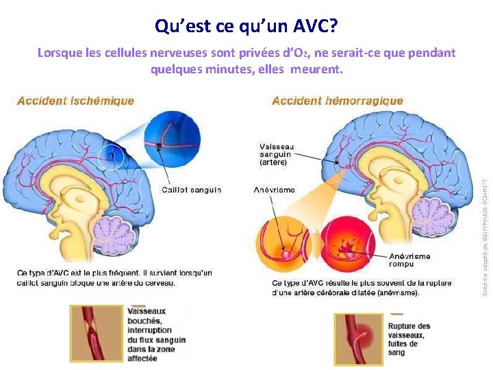 Qu’est ce qu’un AVC? Lorsque les cellules nerveuses sont privées d’O 2, ne serait-ce