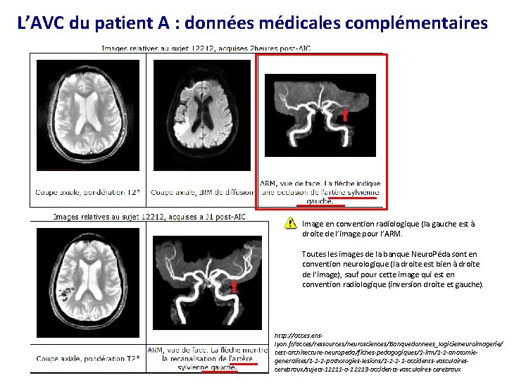 L’AVC du patient A : données médicales complémentaires Image en convention radiologique (la gauche