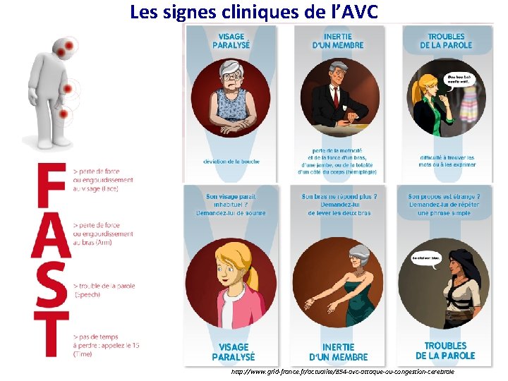 Les signes cliniques de l’AVC http: //www. grid-france. fr/actualite/854 -avc-attaque-ou-congestion-cerebrale 