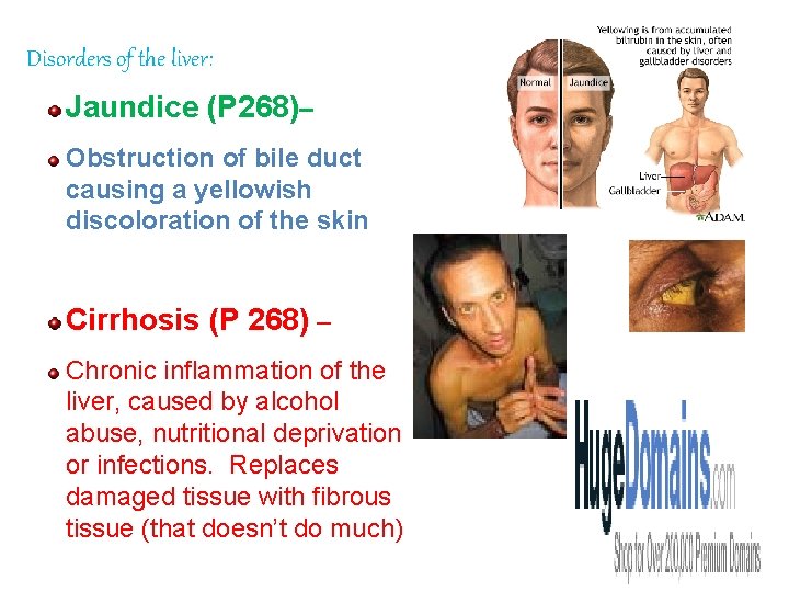 Disorders of the liver: Jaundice (P 268)– Obstruction of bile duct causing a yellowish