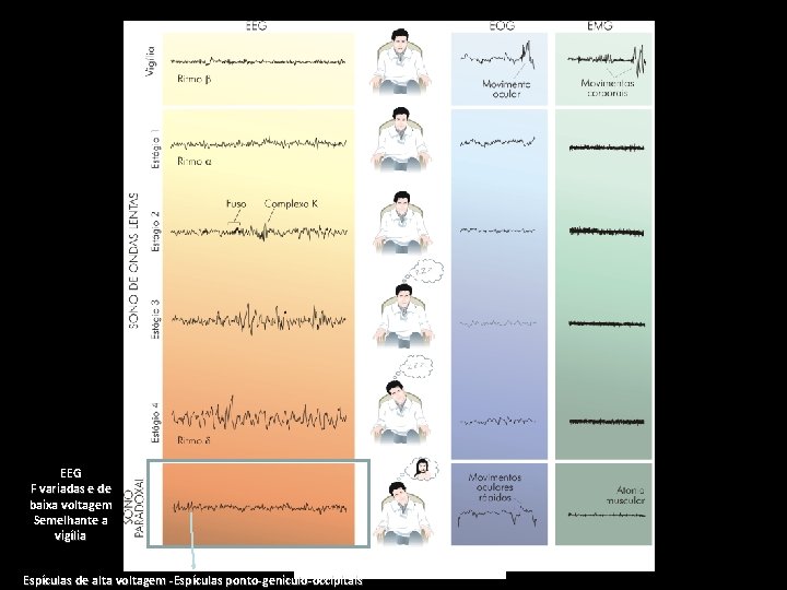 EEG F variadas e de baixa voltagem Semelhante a vigília Espículas de alta voltagem