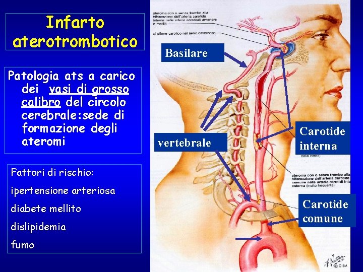 Infarto aterotrombotico Patologia ats a carico dei vasi di grosso calibro del circolo cerebrale: